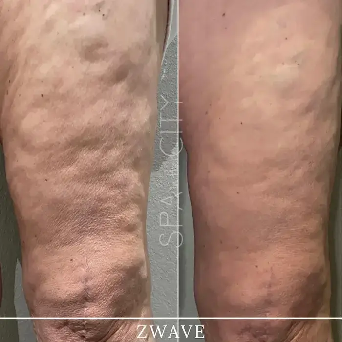 Cellulite Treatments That Work Proven by Dallas Aesthetic Experts