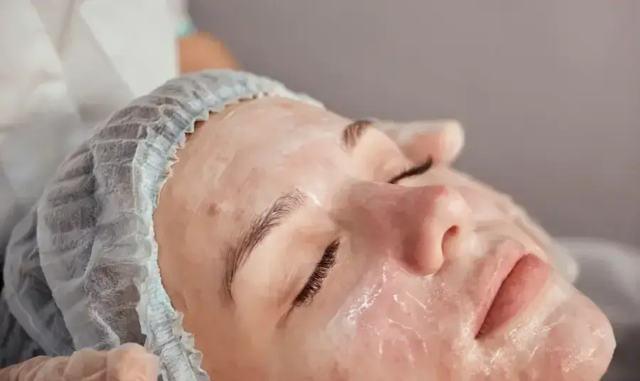 Chemical peels offer powerful benefits for those struggling with ongoing acne breakouts.