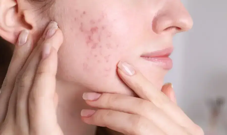 Chemical peels address these lingering effects by improving skin texture and reducing pigmentation irregularities