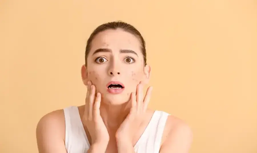 chemical peels have gained popularity as a promising method for managing acne and its lingering effects. 