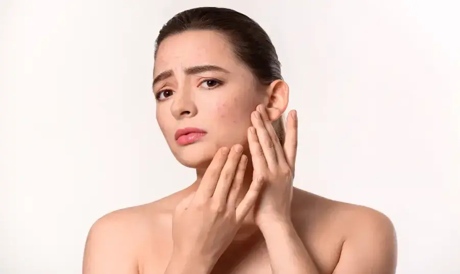 Do Chemical Peels Help With Acne?