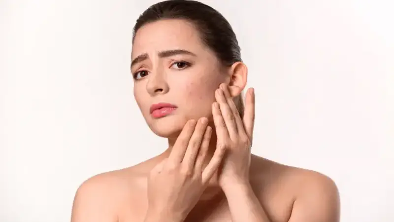 Do Chemical Peels Help With Acne?