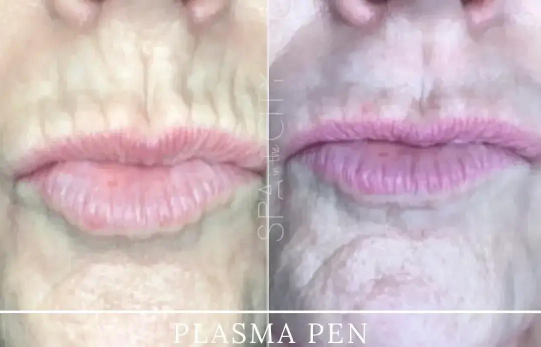 Does Plasma Pen Skin Tightening Really Work? – Dallas Experts Answer