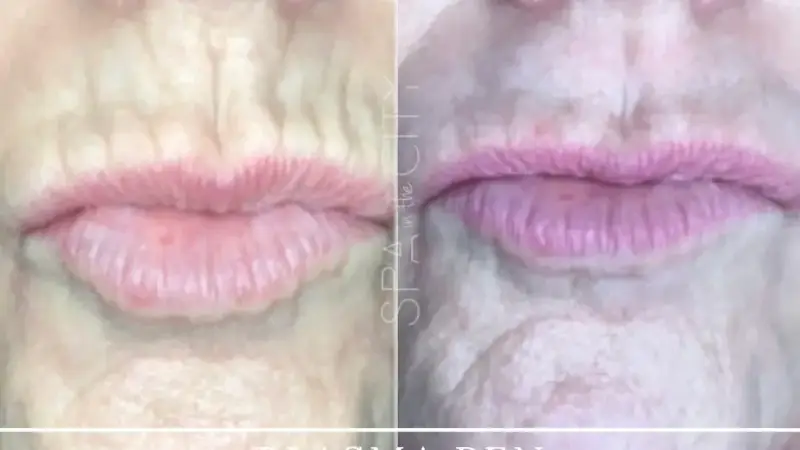 Does Plasma Pen Skin Tightening Really Work? – Dallas Experts Answer