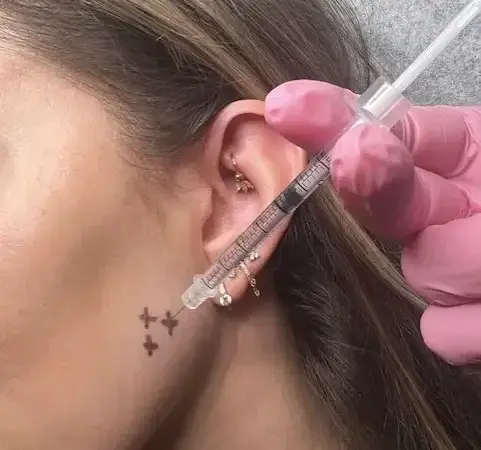 Everything You Need to Know about Masseter Botox in Dallas
