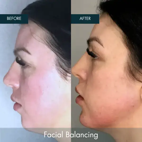 Before and after Facial Balancing at Well Labs+ Dallas, showing the treated cheeks and jawline