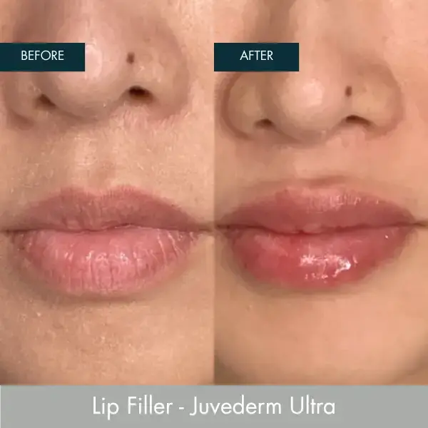 Before and after Lip Filler - Juvederm Ultra at Well Labs+ Dallas, showing the treated lips