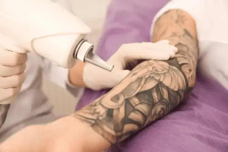 A provider guiding a tattoo removal laser over a client's black-and-grey arm sleeve during a removal session