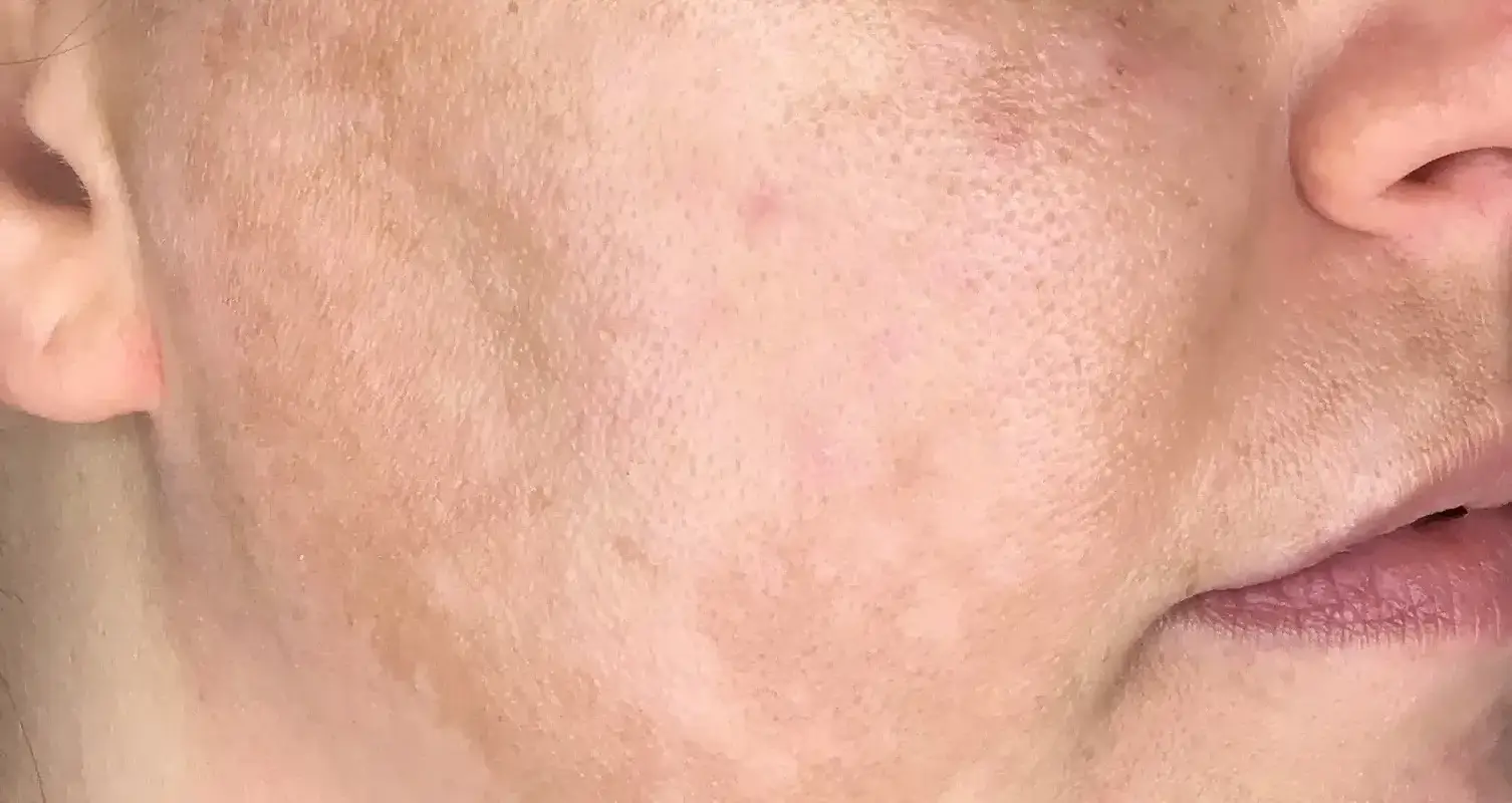 Looking for Melasma Treatments in Dallas? Check Out These Options