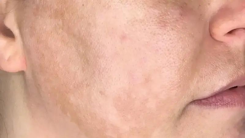 Looking for Melasma Treatments in Dallas? Check Out These Options