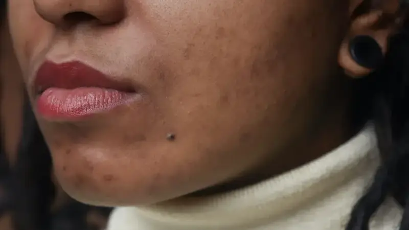 Using SkinPen Microneedling for Acne Scars – Skin Professionals in Dallas
