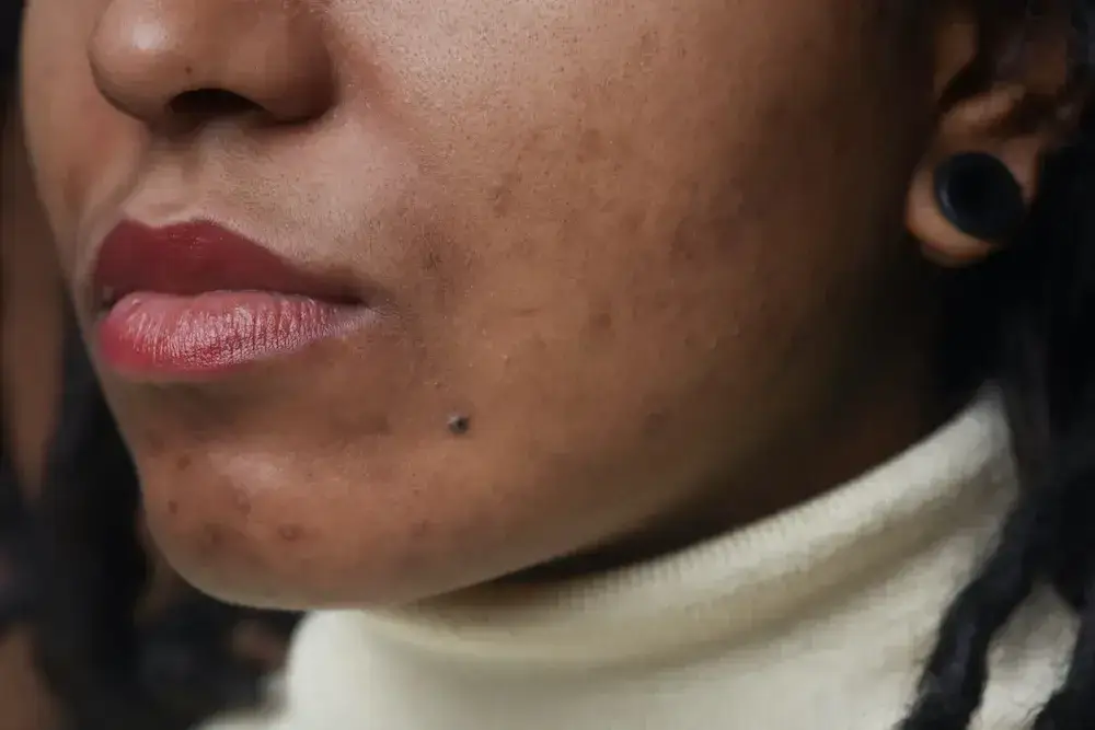Using SkinPen Microneedling for Acne Scars – Skin Professionals in Dallas