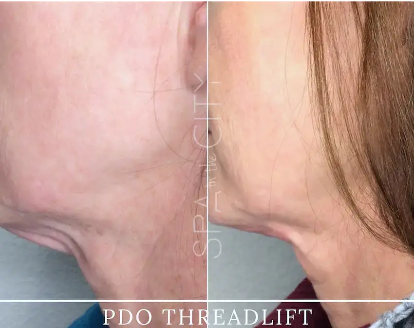 Before and after PDO Smooth Threads at Well Labs+ Dallas, side profile of the jawline and neck