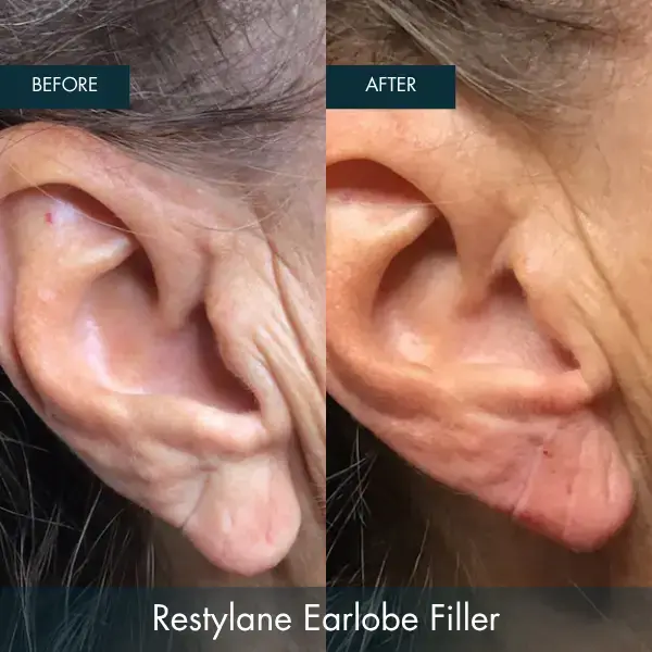 Before and after Restylane Earlobe Filler at Well Labs+ Dallas, showing the treated ears