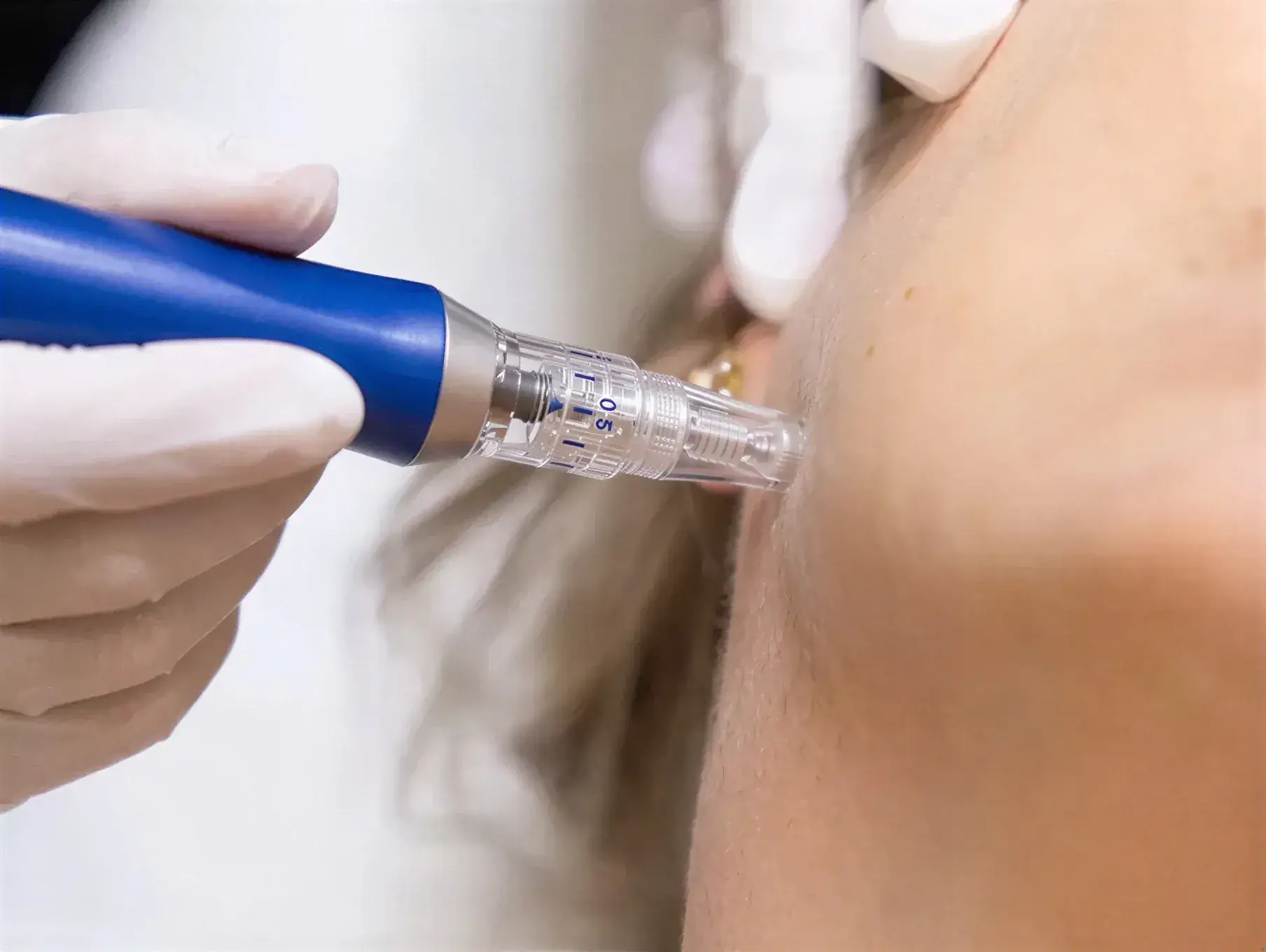 A gloved provider treating a client's skin with the SkinPen microneedling device