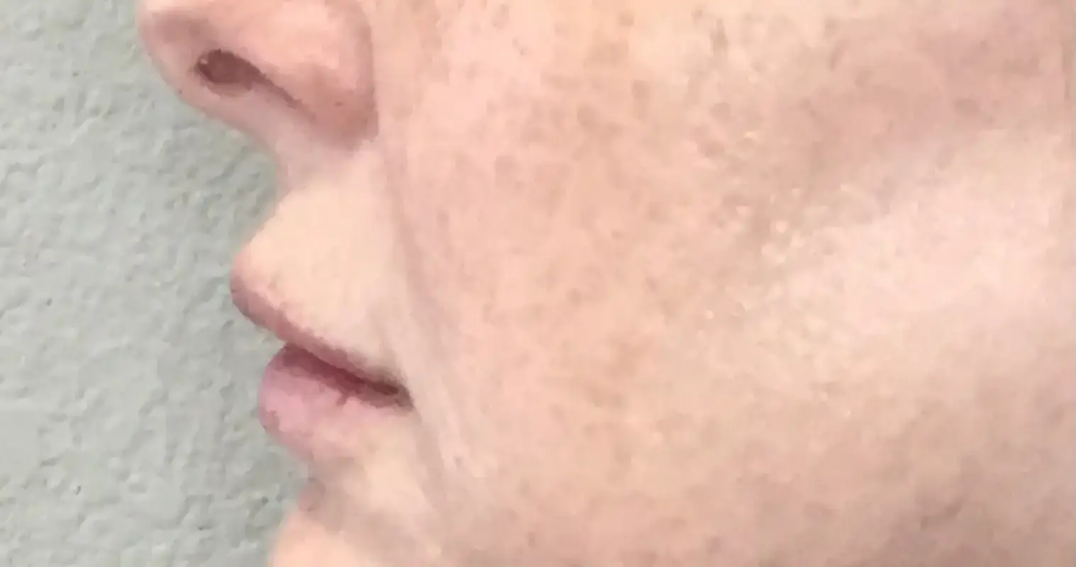 Types of Hyperpigmentation on the Face – Dallas Med Spa