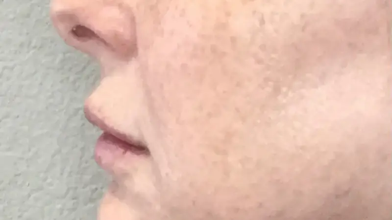 Types of Hyperpigmentation on the Face – Dallas Med Spa