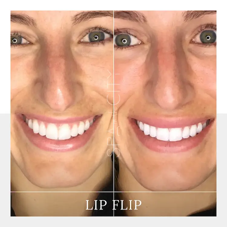 Botox Lip Flip in Dallas - Enhance Lips Naturally Botox Lip Flip in Dallas - Enhance Lips Naturally