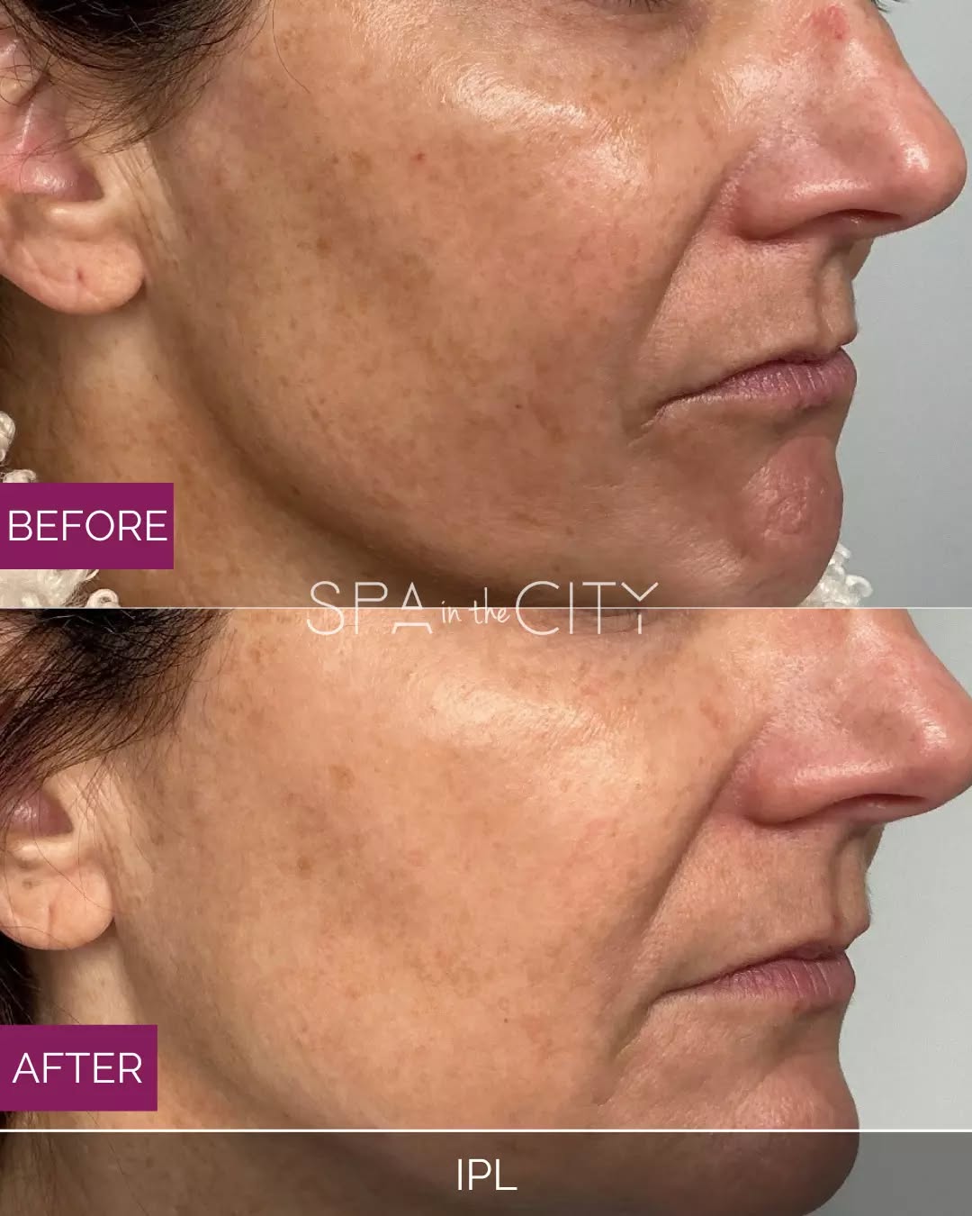 ✨ Real results. Real glow.

These IPL before & afters show how powerful light therapy can be for fading sun damage, redness, and uneven pigmentation. Clearer, brighter skin in just a few sessions.

🔥 This month only: Book an IPL treatment and receive a FREE City Peel.

What’s a City Peel?
Our City Peel is a non-invasive resurfacing treatment that smooths texture, brightens dull skin, adds moisture, and improves sun damage for softer, younger-looking skin.

Ready for your glow-up? ✨
DM us or book your IPL appointment this month to claim your free City Peel! Link in bio😘