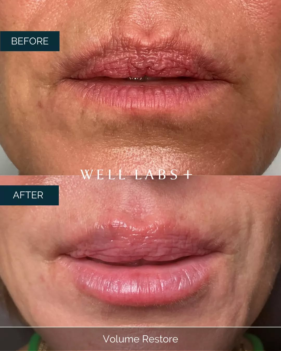 Not overdone. Never obvious.
Just the right amount.💋

💛 Where Advanced Medical Aesthetics Meets Modern Beauty
☎️ 214-238-2251
📍 5009 W Lovers Lane, Dallas
💻 dallas.welllabsplus.com
✨ Let’s get you started