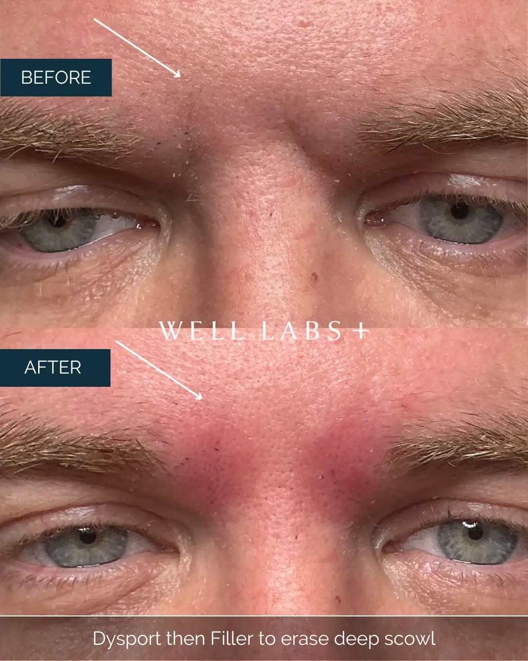 He wasn’t mad… his brows just make it look like he was.🤨

Dysport + filler to smooth the deep “11s” and bring everything back into balance.
Natural > obvious. Always. 💛 

💛 Where Advanced Medical Aesthetics Meets Modern Beauty
☎️ 214-238-2251
📍 5009 W Lovers Lane, Dallas
💻 dallas.welllabsplus.com
✨ Let’s get you started