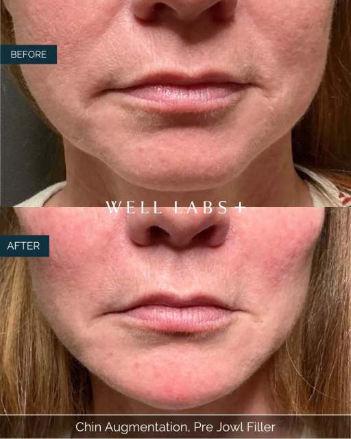 Chin augmentation + pre-jowl filler for a smoother jawline, better balance, and that subtle sculpted look without surgery. Small adjustments. Big difference. 🤍 

💛 Where Advanced Medical Aesthetics Meets Modern Beauty
☎️ 214-238-2251
📍 5009 W Lovers Lane, Dallas
💻 dallas.welllabsplus.com
✨ Let’s get you started