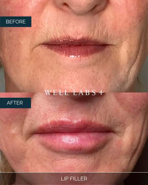 subtle, soft, still you… 💋✨
natural gradual lip filler results that don’t scream “filler”
they whisper: hydrated, balanced, perfected.

💛 Where Advanced Medical Aesthetics Meets Modern Beauty
☎️ 214-238-2251
📍 5009 W Lovers Lane, Dallas
💻 dallas.welllabsplus.com
✨ Let’s get you started