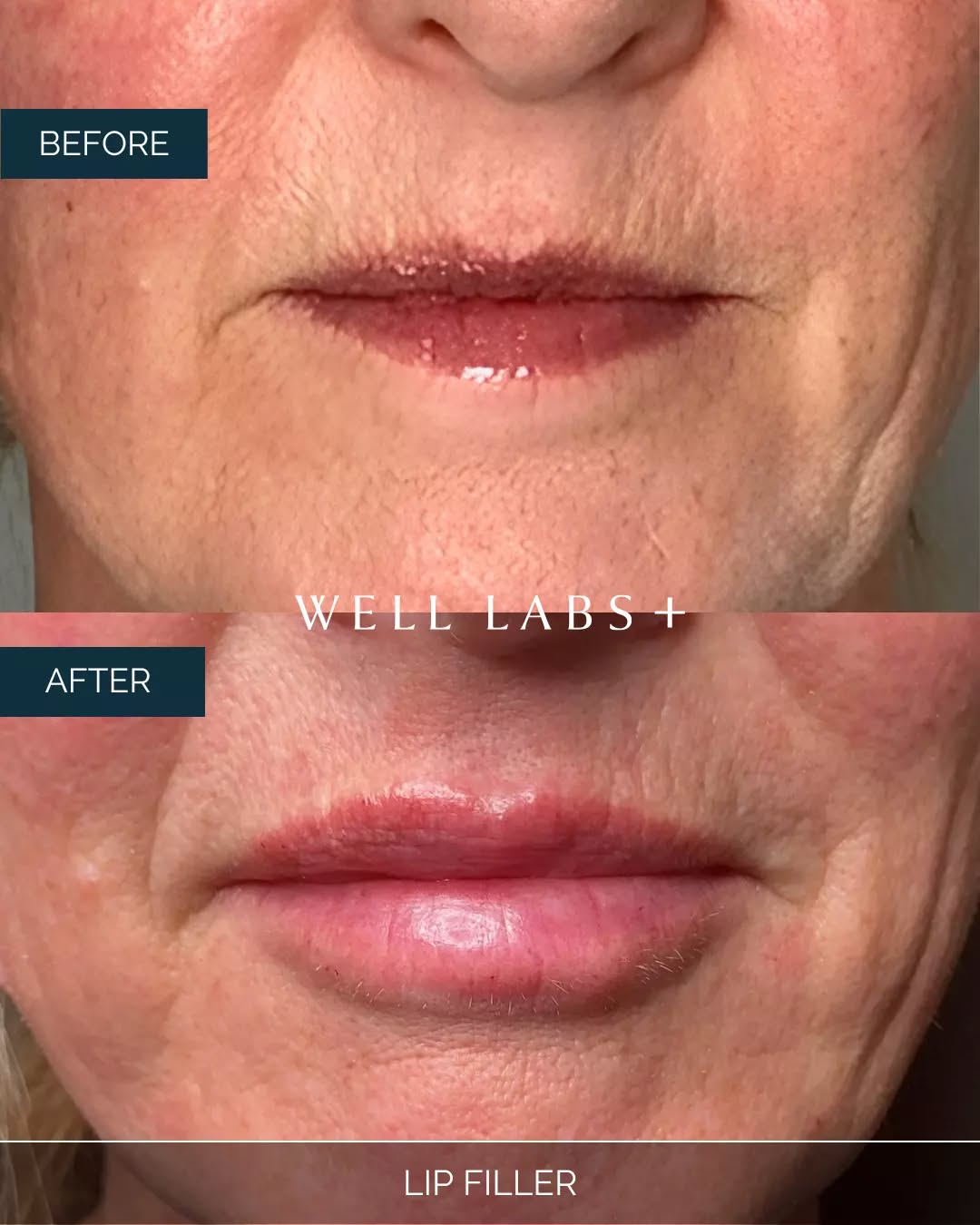 subtle, soft, still you… 💋✨
natural gradual lip filler results that don’t scream “filler”
they whisper: hydrated, balanced, perfected.

💛 Where Advanced Medical Aesthetics Meets Modern Beauty
☎️ 214-238-2251
📍 5009 W Lovers Lane, Dallas
💻 dallas.welllabsplus.com
✨ Let’s get you started