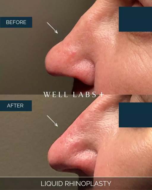 10 minutes. No downtime. Your dream nose. 👃

💛 Where Advanced Medical Aesthetics Meets Modern Beauty
☎️ 214-238-2251
📍 5009 W Lovers Lane, Dallas
💻 dallas.welllabsplus.com
✨ Let’s get you started