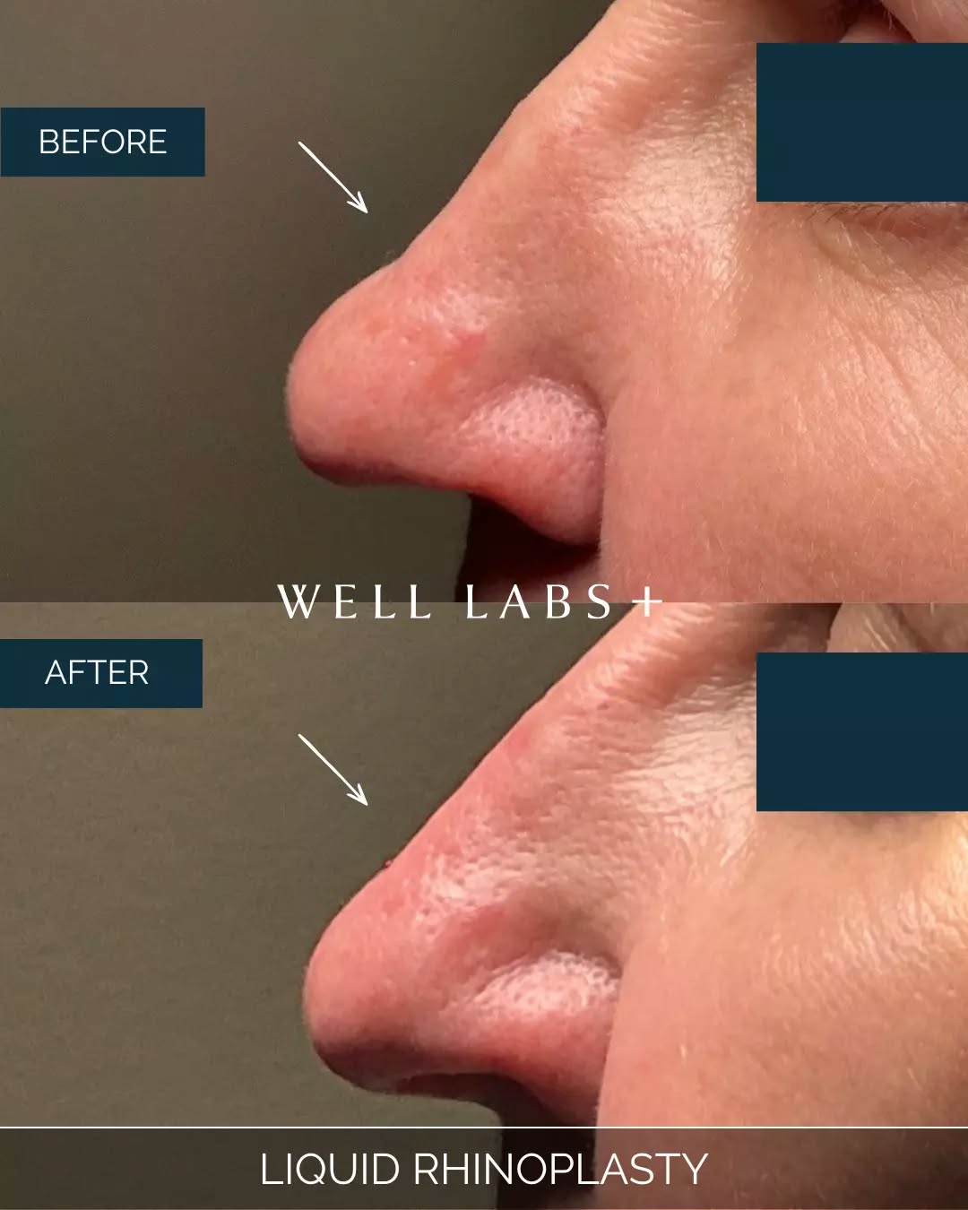 10 minutes. No downtime. Your dream nose. 👃

💛 Where Advanced Medical Aesthetics Meets Modern Beauty
☎️ 214-238-2251
📍 5009 W Lovers Lane, Dallas
💻 dallas.welllabsplus.com
✨ Let’s get you started