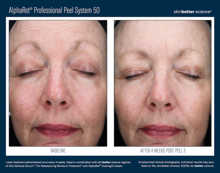 AlphaRet-Professional-Peel-System-Before_After