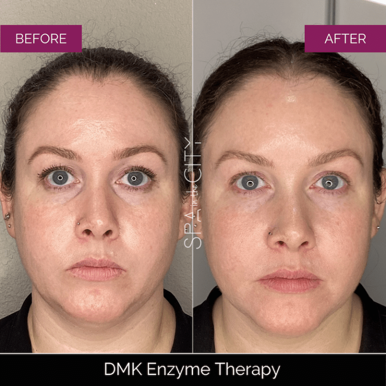DMK-Enzyme-Therapy before after