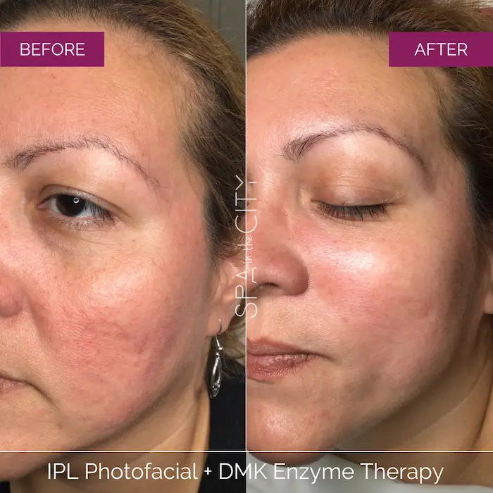 DMK-Enzyme-Therapy before after one