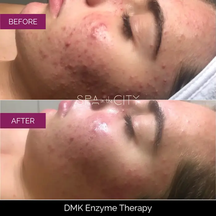 DMK Skincare before after one