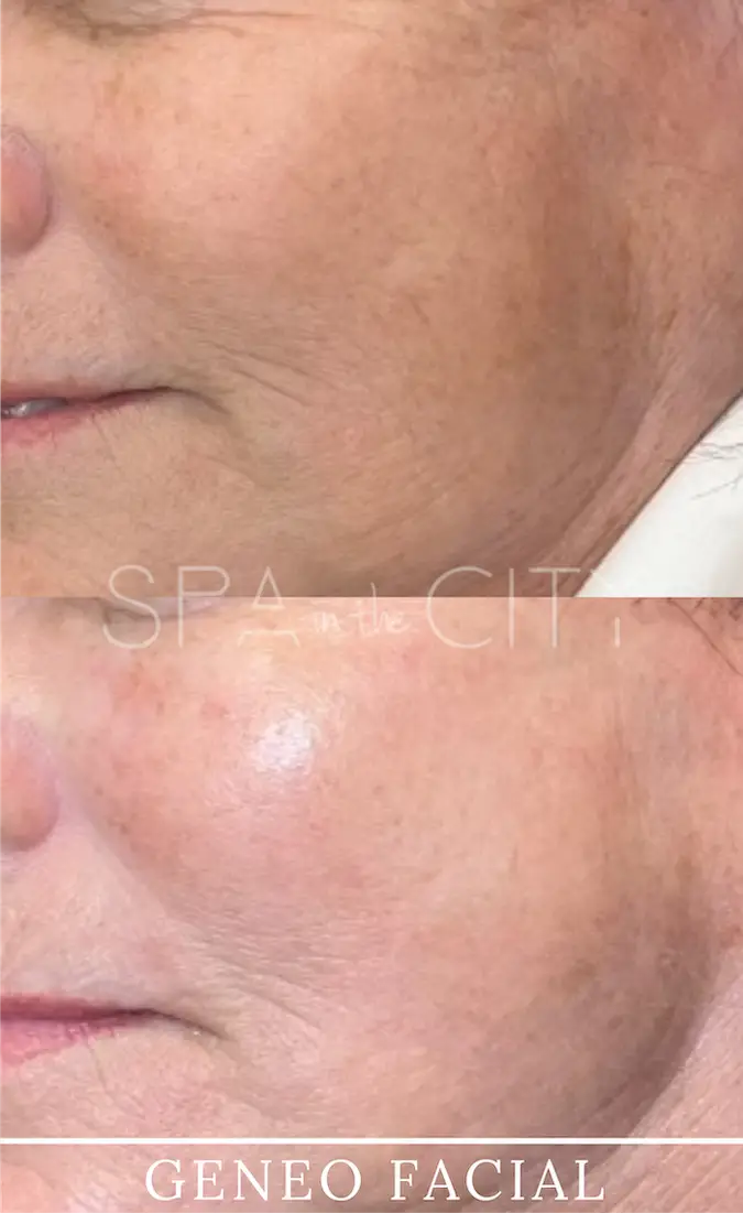 Glo2 Facial before after one