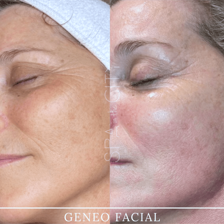 Glo2 Facial before after two