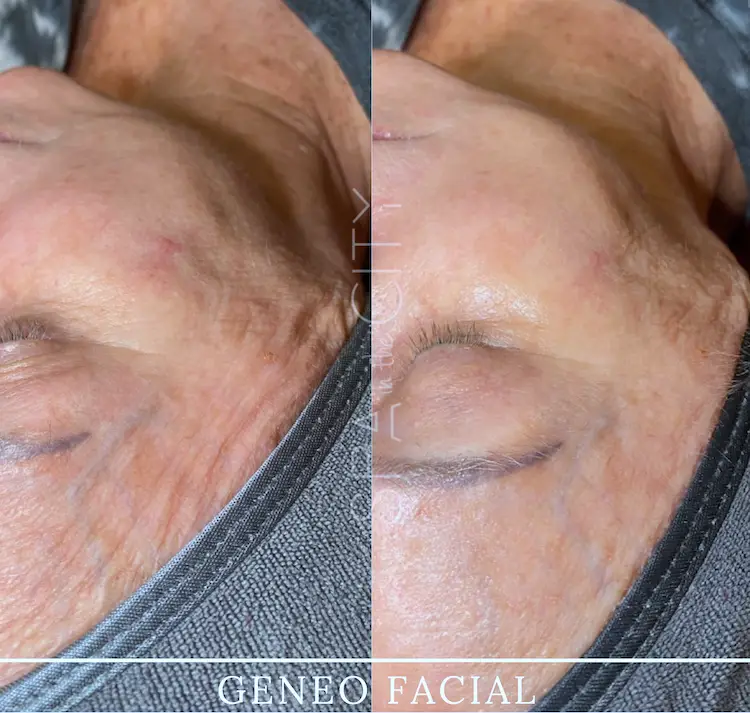 Glo2 Facial before after