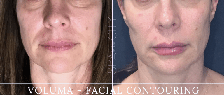 Juvéderm injection before and after