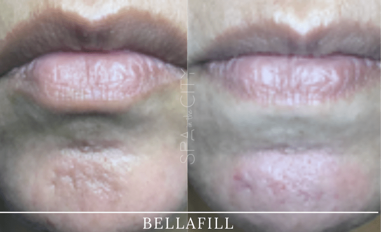 RF microneedling before after one