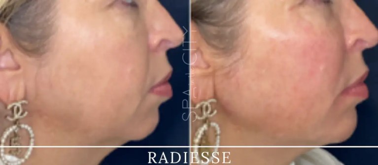 Radiesse before and after one