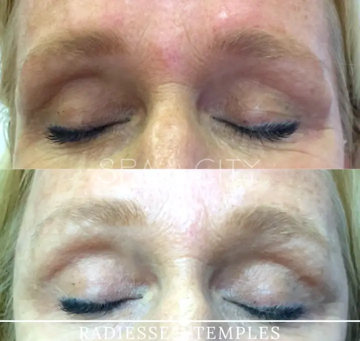 Radiesse before and after