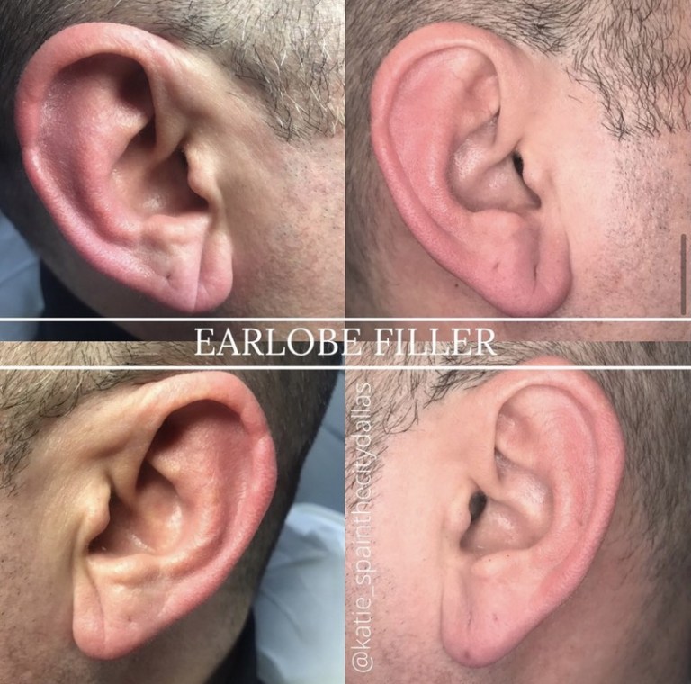 Restylane fillers ear