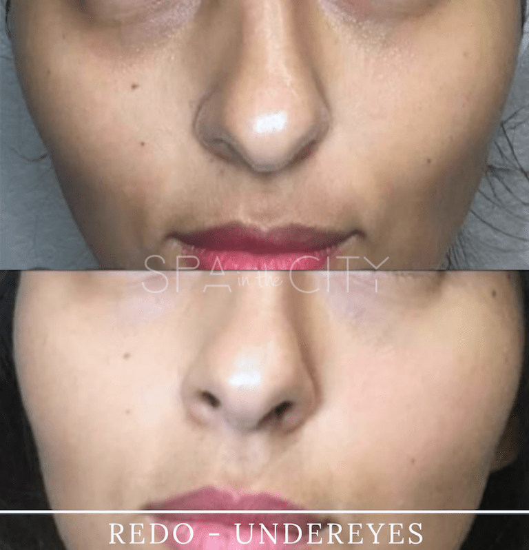 SITC-BA-REDO-Skin-Resurfacing before after