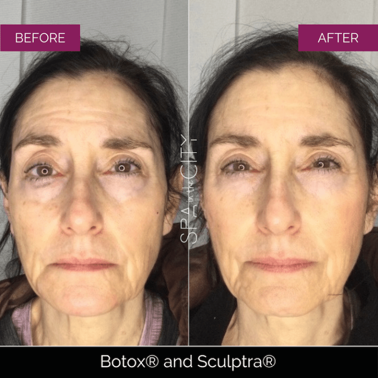 Sculptra before after