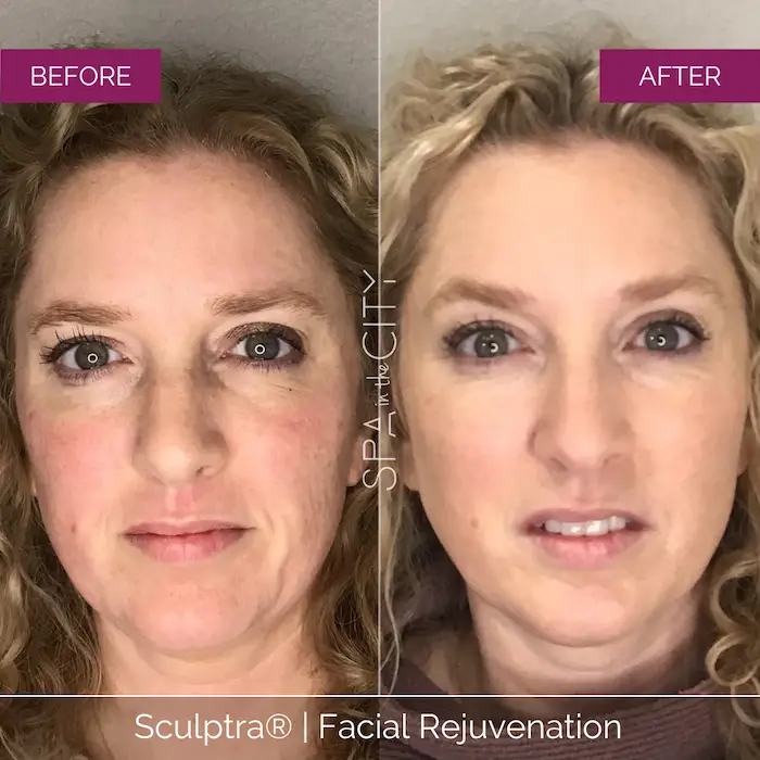 Sculptra before after one
