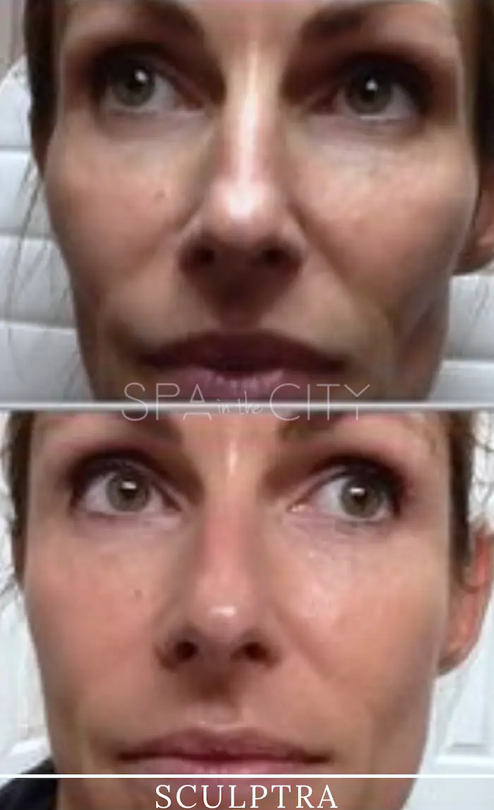 Sculptra before after two