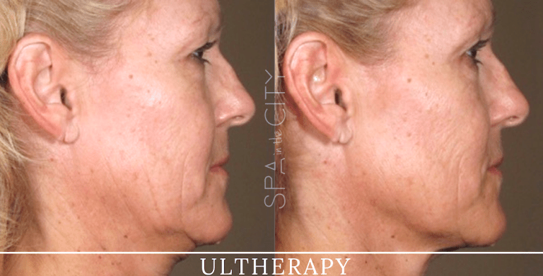 Ultherapy before after