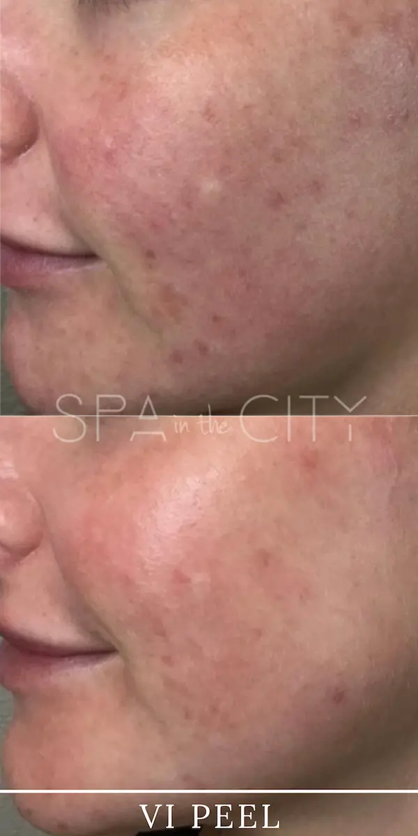 VI Peel before after one