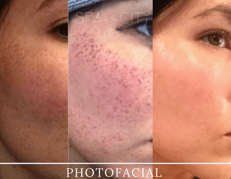 cheeks photofacial