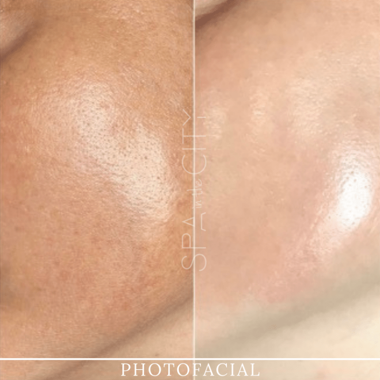 cheeks photofacial before after